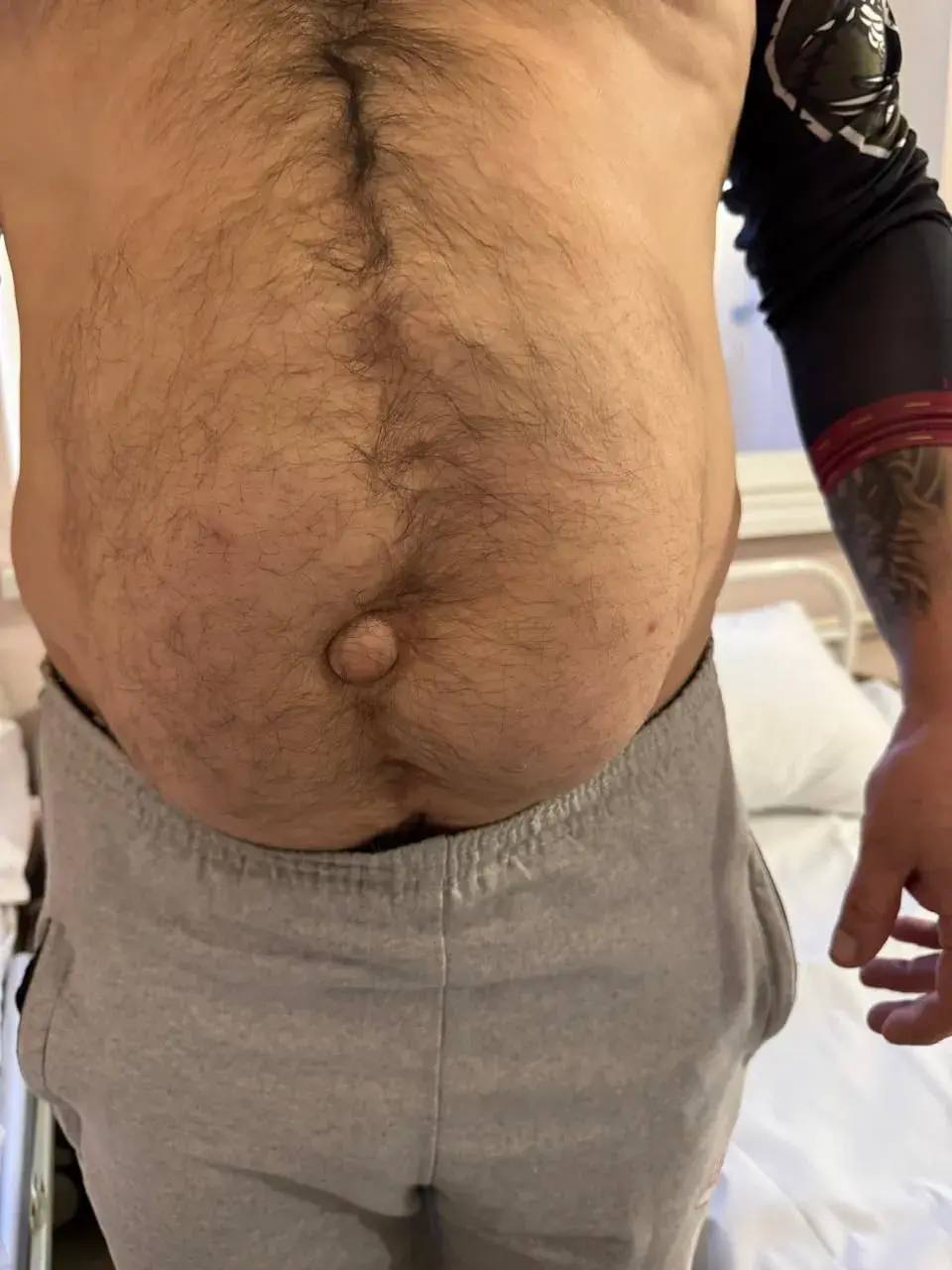 Ростовские хирурги спасли пациента с гигантской грыжей после десяти операций