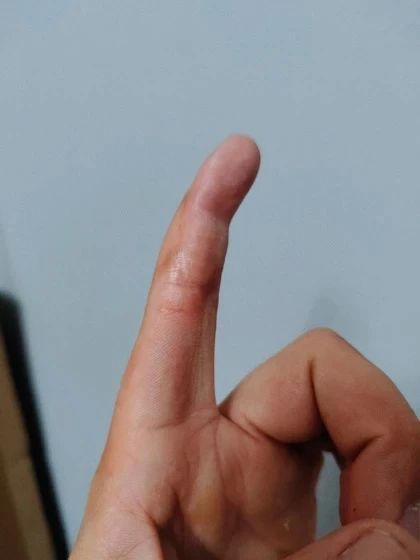 В Ростове врачи шесть часов спасали руку ростовчанина, получившего травму во время ремонта